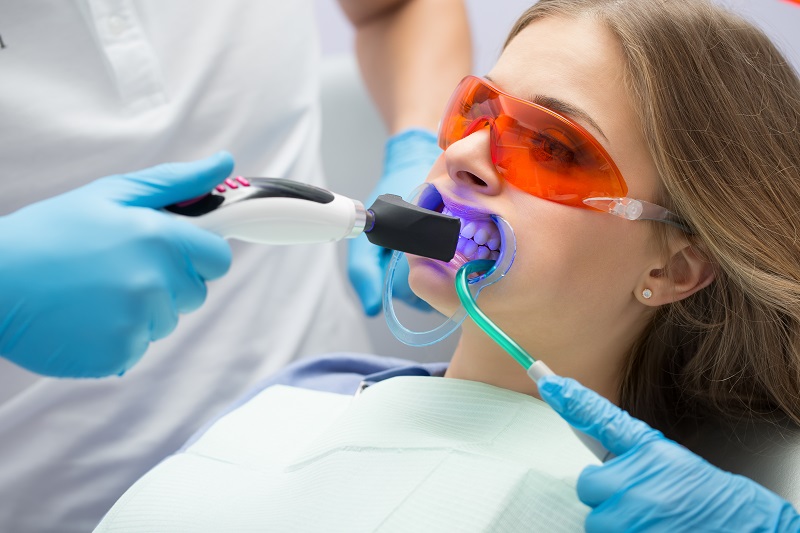 blanchiment des dents au Laser